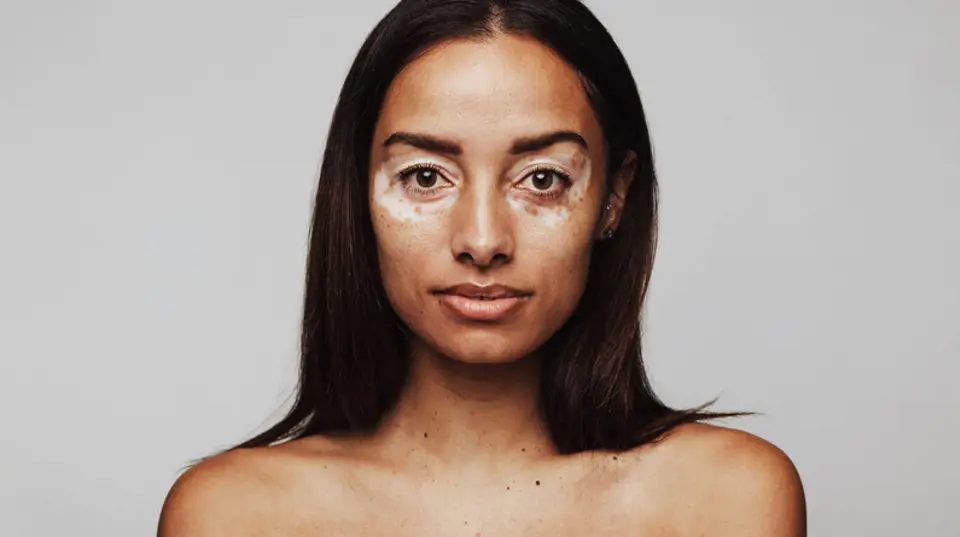 Vitiligo Belirtisi Nelerdir?