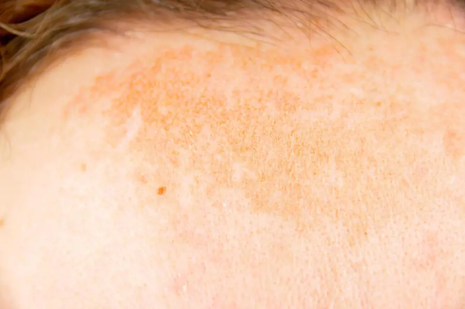 Cilt lekeleri (Melasma)