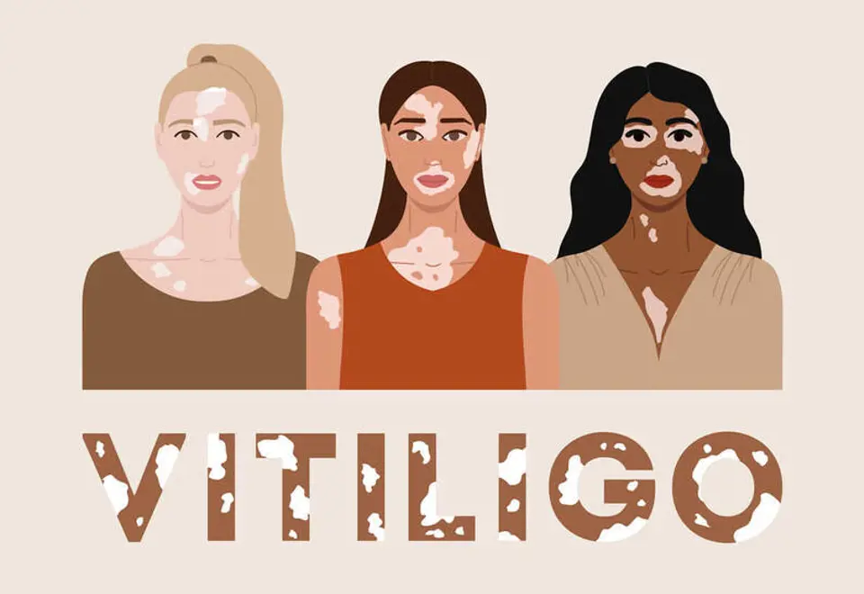 Vitiligo Nasıl Geçer?